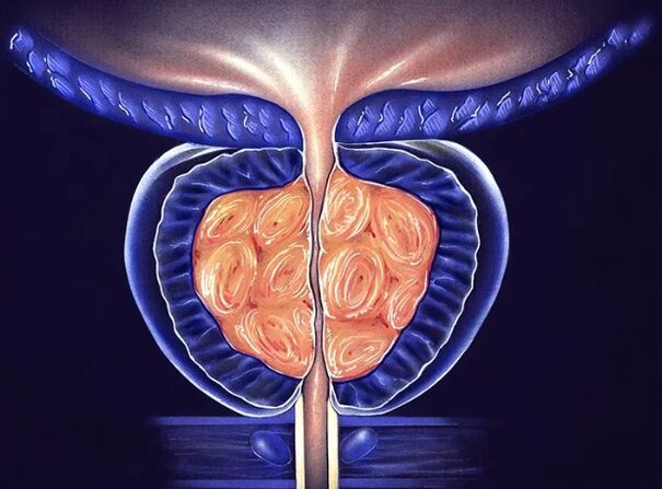 Chronic bacterial prostatitis in men
