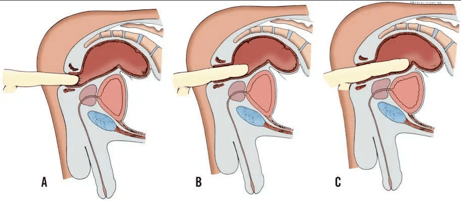Finger rectal examination
