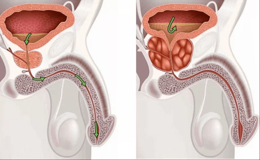 Symptoms of prostatitis